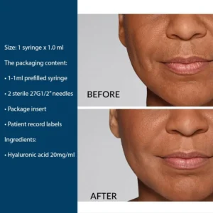 the art of facial sculpting with Restylane®, which is expertly crafted and designed for optimal patient comfort. Restylane Defyne Lidocaine Dermal Filler
