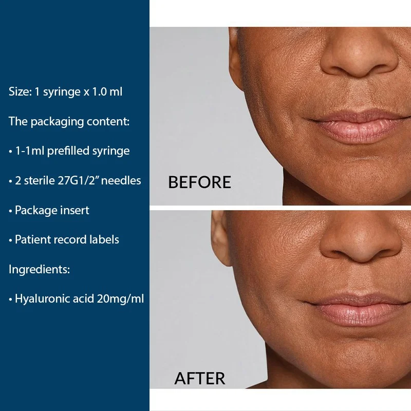 3-74 the art of facial sculpting with Restylane®, which is expertly crafted and designed for optimal patient comfort. Restylane Defyne Lidocaine Dermal Filler